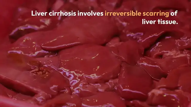 Video thumbnail for Understanding Liver Cirrhosis Risks