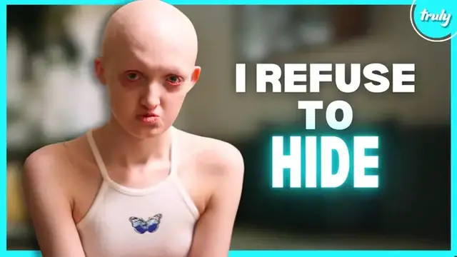 Video thumbnail for My Rare Condition Took My Hair & Teeth | BORN DIFFERENT