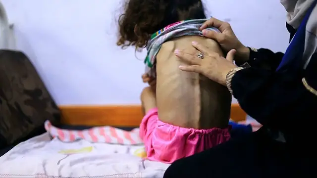 'Video thumbnail for Severe malnutrition grips Gaza’s children as blockade seals borders'