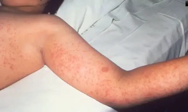 Video thumbnail for Connecticut becomes one of first states to join new U.S. disease tracking system