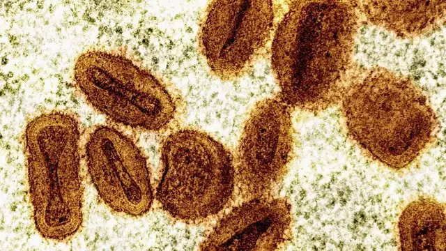 'Video thumbnail for Mpox outbreak no longer a global health emergency, WHO chief says'