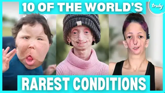 'Video thumbnail for 10 Incredible People Who Defied The Rarest Conditions | BORN DIFFERENT'