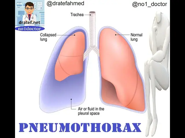 Video thumbnail for Pneumothorax  / Causes /  Pathology / Symptoms / Diagnosis / Treatment / Medical Lecture / No1doctor