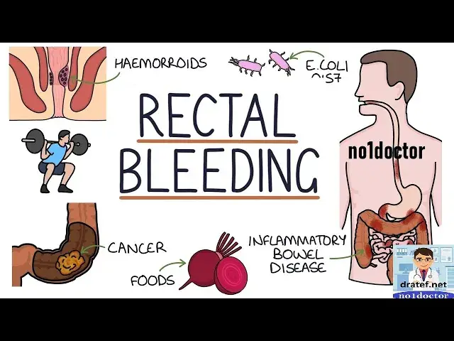 Video thumbnail for Bleeding Per Rectum /Rectal Bleeding /Causes/Diagnosis /treatment /piles/fissure/cancer/angiodysplas