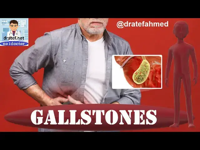 Video thumbnail for Gallstones/ Cholelithiasis / Causes /Symptoms /Diagnosis /Treatment / Pathology/Medical Case/ Exame