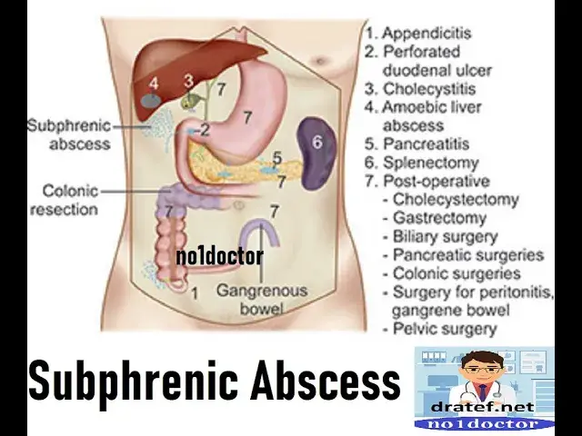Video thumbnail for Subdiaphragmatic Abscess /Subphrenic Abscess/ Subphrenic Spaces  /Gastrointestinal System /no1doctor