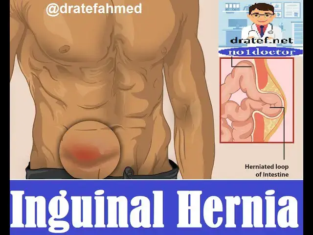 Video thumbnail for Inguinal Hernia Case  / Medical Long Case/ Medical  case discussion / Medical Exame / Surgical Case