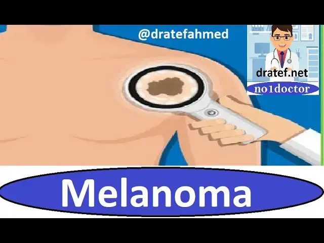 'Video thumbnail for Melanoma /skin disease/ cancer skin /malignancy / medical student / /medical exam / case discussion'