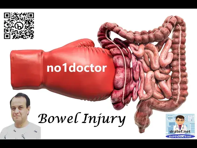 Video thumbnail for Bowel Injury  and Trauma surgery Everything You Need to Know #bowelinjurytreatment #bowelinjuryrecov
