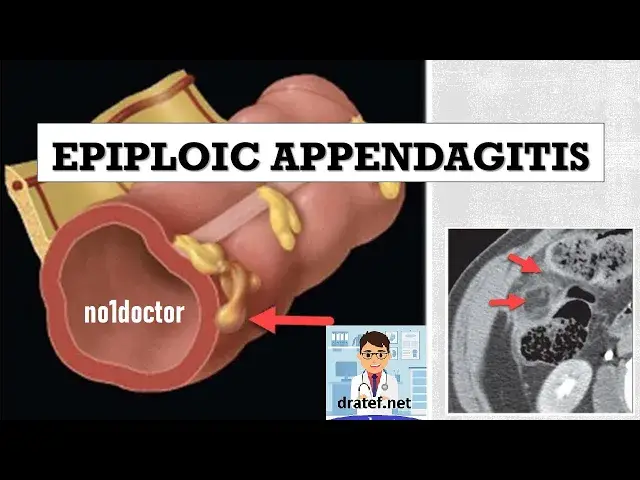 Video thumbnail for Epiploic Appendagitis /Appendictis/Acute Diverticulitis/Acute Omental Infarction /Panniculitis/Usmle