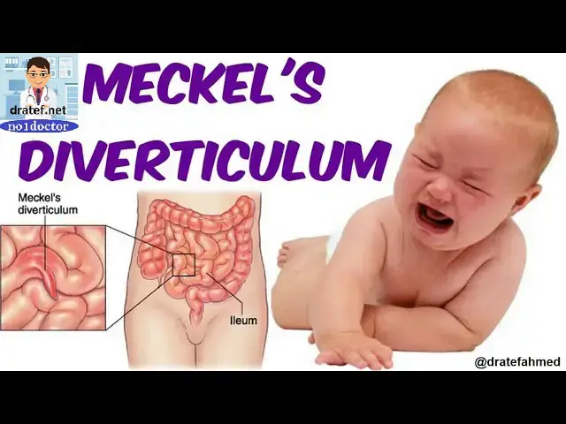 Video thumbnail for Meckel's Diverticulum /Meckel's Diverticulum Surgery/ Management of Symptomatic Meckel's Diverticula