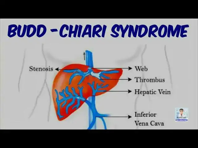 Video thumbnail for Budd–Chiari syndrome