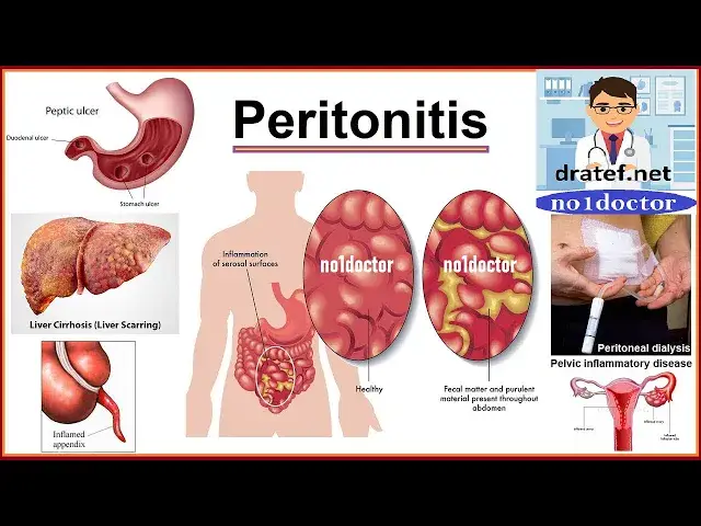 Video thumbnail for Waht is the peritonitis Acute Abdomen,/Appendicitis & Peritonitis/ General Surgery Lecture/Mrcs/Frcs