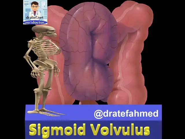 'Video thumbnail for Sigmiod Volvulus / Causes / Pathology / Symptoms / Diagnosis /Treatment /Medical Lecture /No1doctor'