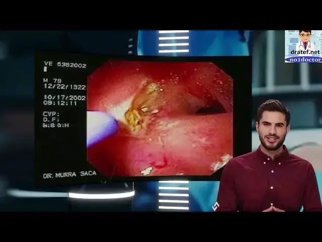 Video thumbnail for Duodenal ulcer /Peptic Ulcer Disease/GASTRIC VS DUODENAL ULCERS/endoscopy/Heart Burn /abdominal pain