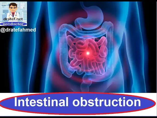 Video thumbnail for Intestinal obstruction / Case Presentation / Medical Case Study / Case Discussion/  Case Report