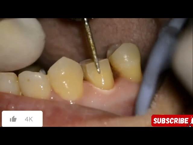 Video thumbnail for Vertical Tooth Preparation (Verti Prep) | Step by Step