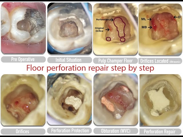 Video thumbnail for Management of floor perforation