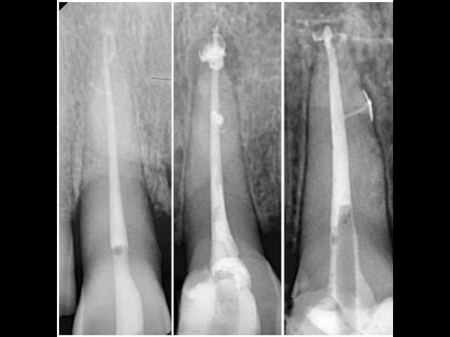 Video thumbnail for Lateral and Accessory Canals in Endodontics: A Complete Clinical Guide | Dentistry Simplified Ep.3