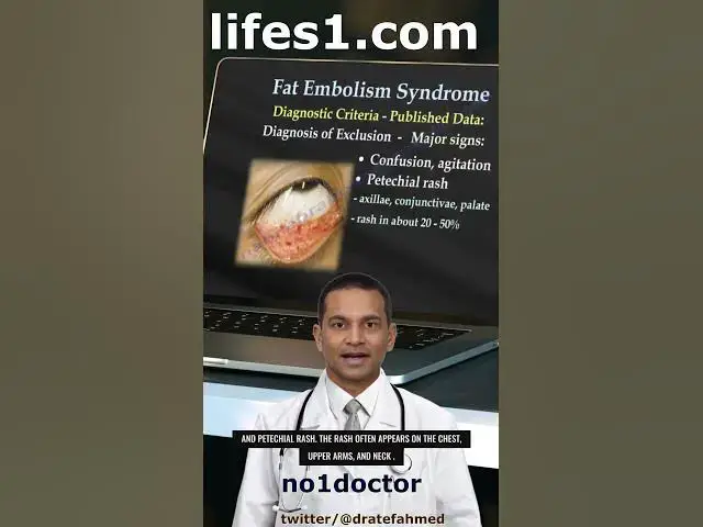 Video thumbnail for "Understanding Fat Embolism Syndrome: Causes, Symptoms, and Treatment Options"  #shorts #trauma