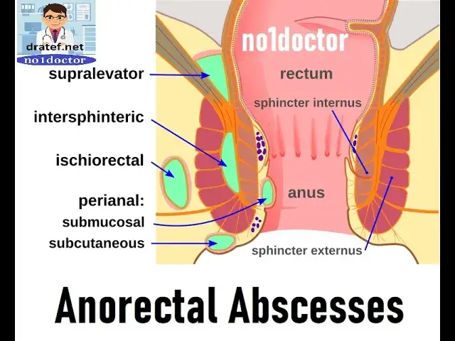 'Video thumbnail for Anorectal abscesses/Anal abscess/Rectal abscess/Perirectal abscess/ Perianal abscess/ Gland abscess'