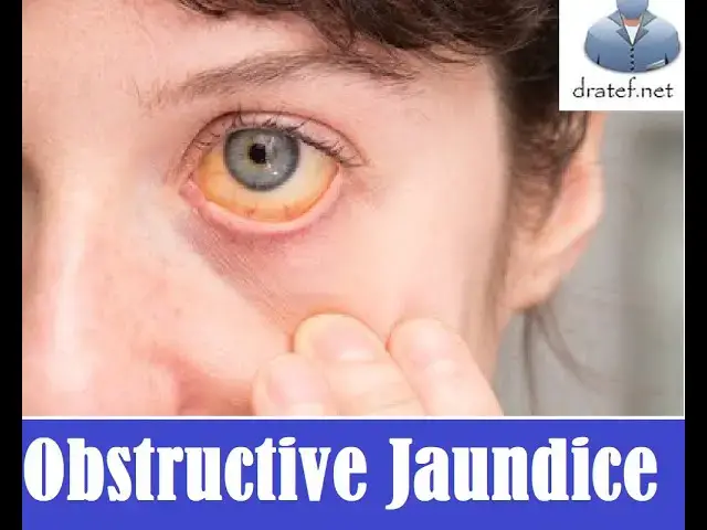 Video thumbnail for Obstructive Jaundice / Clinical Presentation / Gall Stone /  Medical  Case Discussion  / Case Report