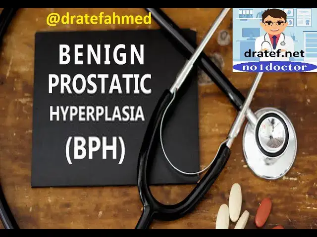 Video thumbnail for Benign Prostatic Hyperplasia ( BPH ) / Enlarged Prostate / Prostate Cancer / Medical Case Discussion