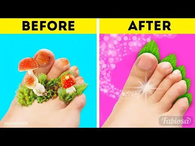 Video thumbnail for 12 Ways To Get Rid of Toenail Fungus Fast and Naturally