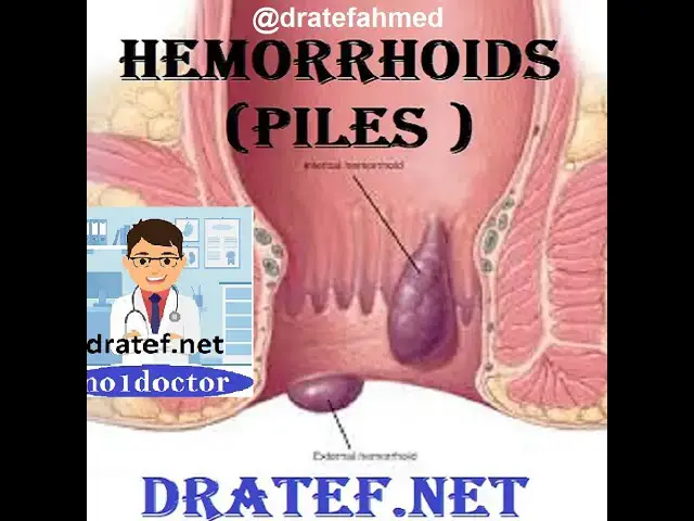 Video thumbnail for Lecture Notes On Hemorrhoids / Piles / Hemorrhoid Surgery / What are hemorrhoids  / Medical lecture
