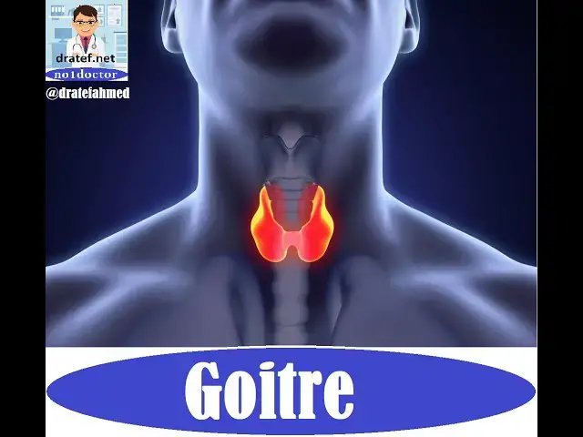 Video thumbnail for Goitre /Thyroid Gland Diseases/Case Presentation / Medical Case Study/  Case Discussion /Case Report