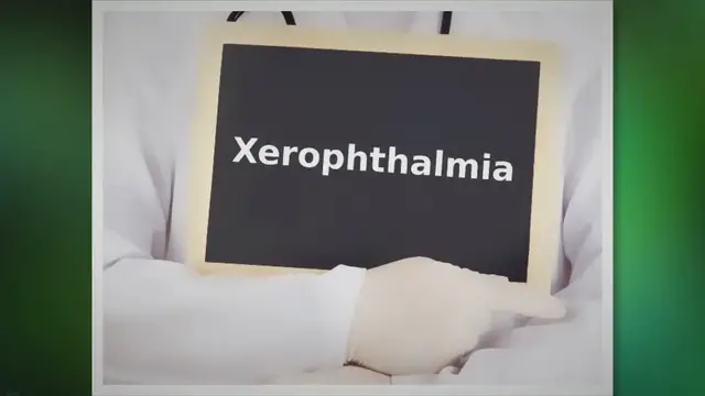 Video thumbnail for What is xerophthalmia & how is it treated? - An Eye Care Blog