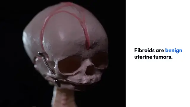 'Video thumbnail for Vitamin_D_s_Impact_on_Fibroids'