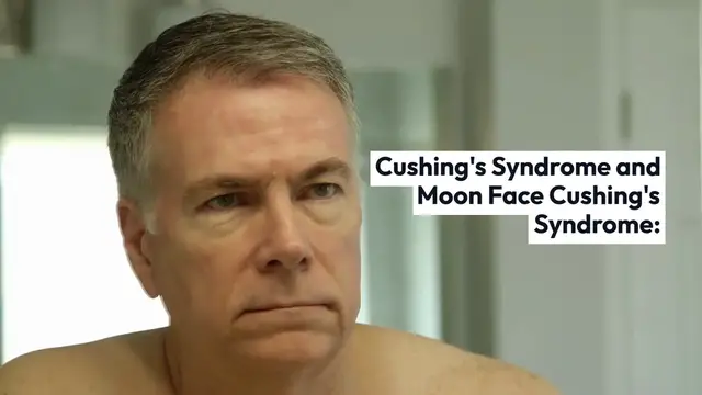 'Video thumbnail for Understanding_Moon_Face_Syndrome'