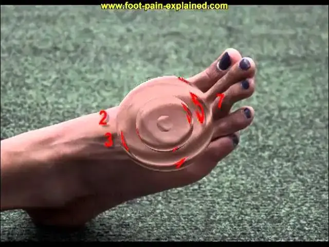'Video thumbnail for superficial nerve entrapment'