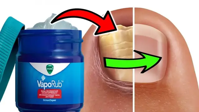 Video thumbnail for HOW TO USE VICKS VAPORUB TO TREAT TOENAIL FUNGUS