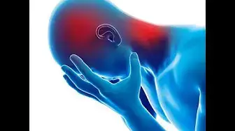 Video thumbnail for Medication overuse headache #Shorts￼