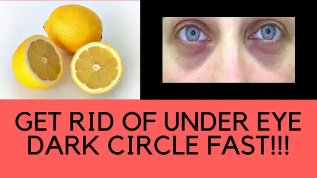 'Video thumbnail for How To Get Rid Of Dark Circles Under Eyes Permanently Fast - Remove Dark Circles Naturally Overnight'