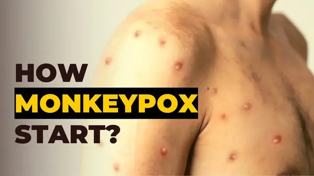 Video thumbnail for Where did Monkeypox Come From - History of Monkeypox Outbreak
