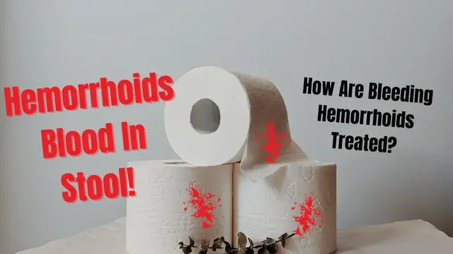 Video thumbnail for Hemorrhoids Blood In Stool