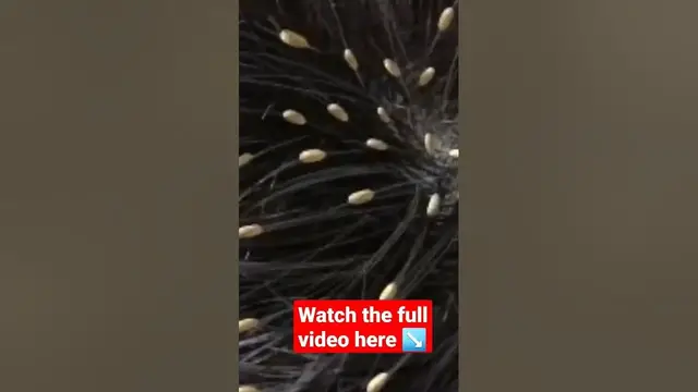'Video thumbnail for How To Get Rid of Head Lice With Tea Tree Oil'