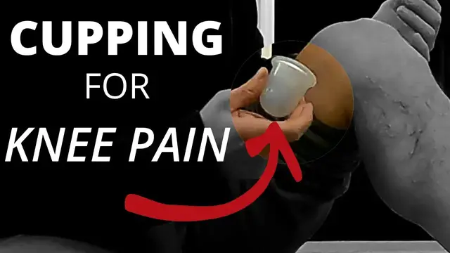 'Video thumbnail for Cupping for Knee Pain | Cupping After A Total Knee Replacement'