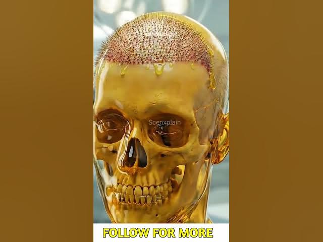 Video thumbnail for हेयर ट्रांसप्लांट करवाने से पहले देख लो #shorts #awareness