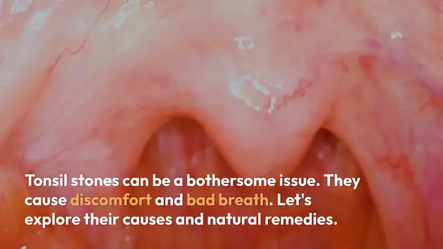 Video thumbnail for Tonsil Stones Causes and Remedies