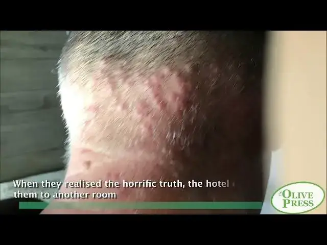 Video thumbnail for Turning on the light in your four-star Mallorca hotel to swarms of BED BUGS