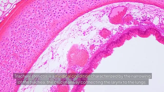 Video thumbnail for Airway Narrowing: Causes and Solutions