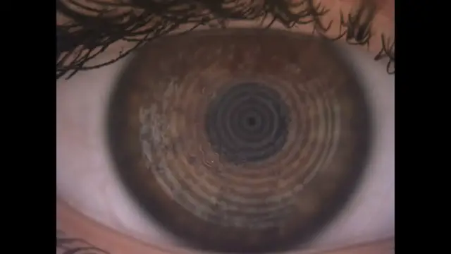 Video thumbnail for Debris on a contact lens