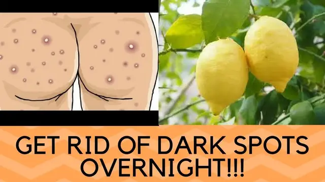 'Video thumbnail for HOW TO GET RID OF DARK SPOTS ON THE BUTTOCKS OVERNIGHT NATURALLY - HOME REMEDIES FOR DARK SPOTS'
