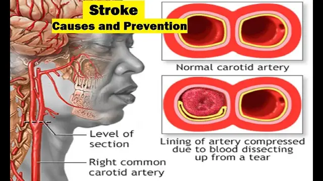 'Video thumbnail for Stroke : Causes and prevention'