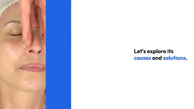 Video thumbnail for Natural Solutions for Cellulite