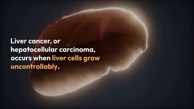 Video thumbnail for Understanding Liver Cancer Risks